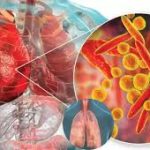 साइलेंट निमोनिया के बढ़ते मामले