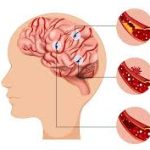ब्रेन स्ट्रोक के लक्षण