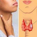 महिलाओं में थायरॉइड कैंसर के बढ़ते खतरे पर विशेषज्ञों की चेतावनी, जागरूकता और नियमित जांच पर जोर