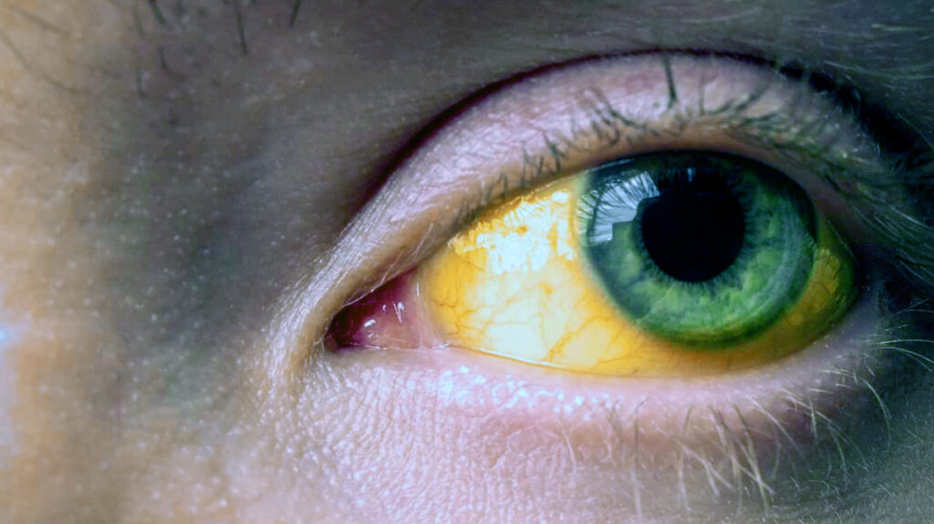 ओडिशा में पीलिया के मामले, लक्षण और बचाव उपाय