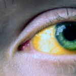 ओडिशा में पीलिया के मामले, लक्षण और बचाव उपाय